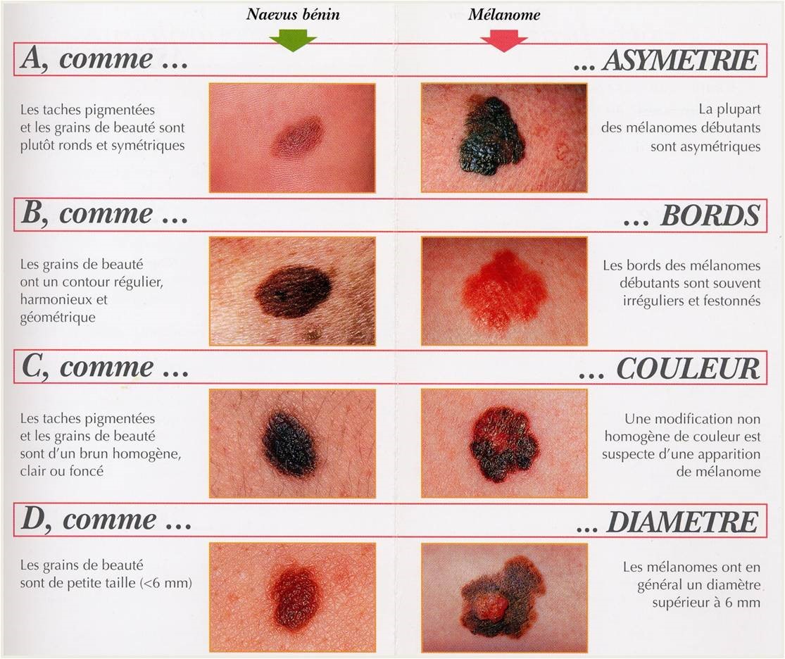 Type de cancer de la peau